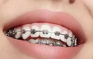 ortodonti-nedir-min-825x500-1.jpg