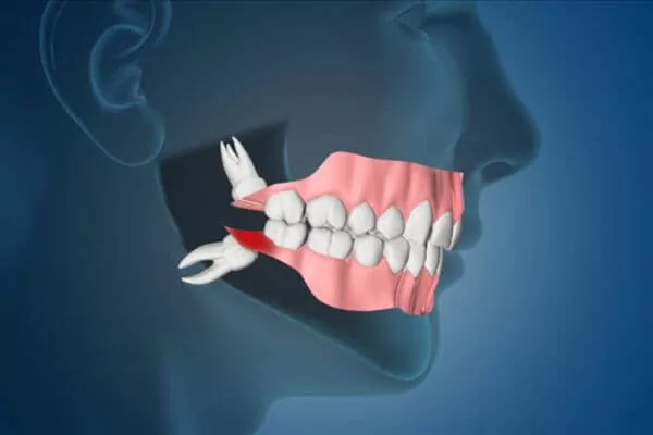wisdom teeth Good Samaritan Dental Implant Institute